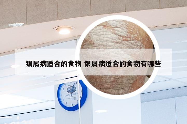 银屑病适合的食物 银屑病适合的食物有哪些