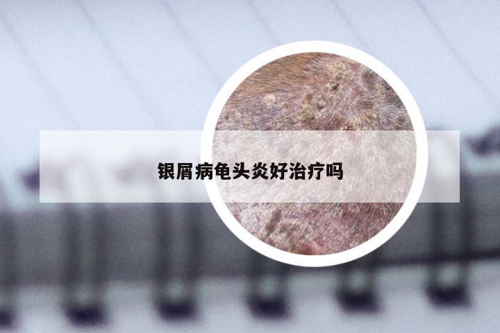 银屑病龟头炎好治疗吗