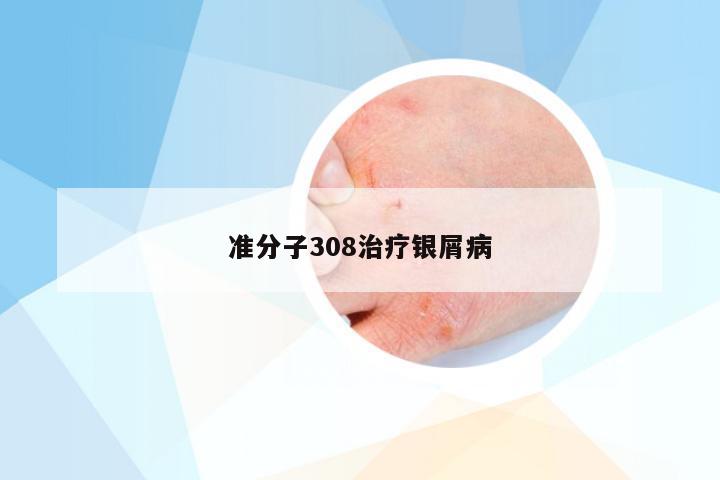 准分子308治疗银屑病
