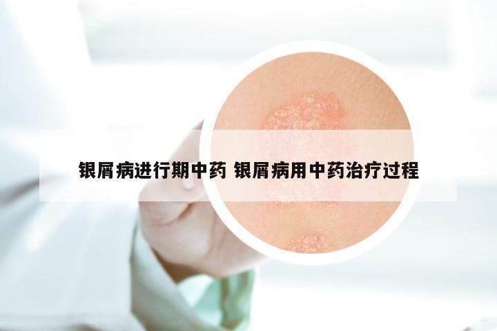 银屑病进行期中药 银屑病用中药治疗过程