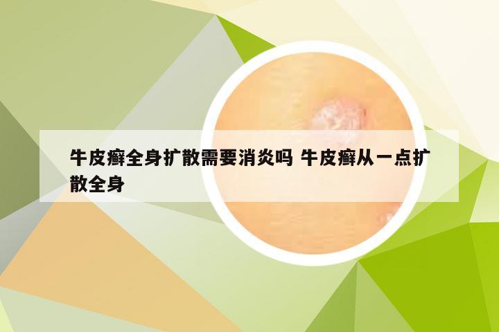 牛皮癣全身扩散需要消炎吗 牛皮癣从一点扩散全身