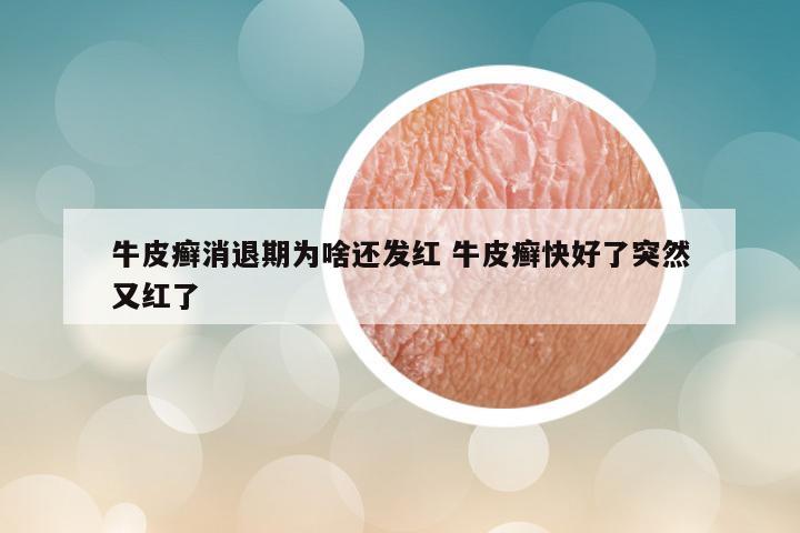 牛皮癣消退期为啥还发红 牛皮癣快好了突然又红了