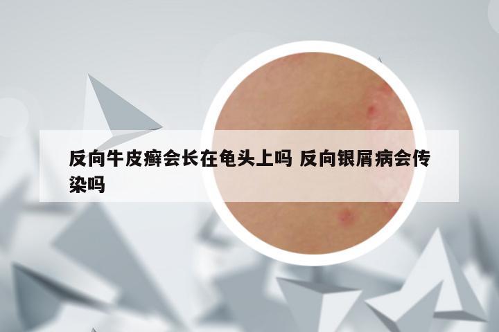 反向牛皮癣会长在龟头上吗 反向银屑病会传染吗