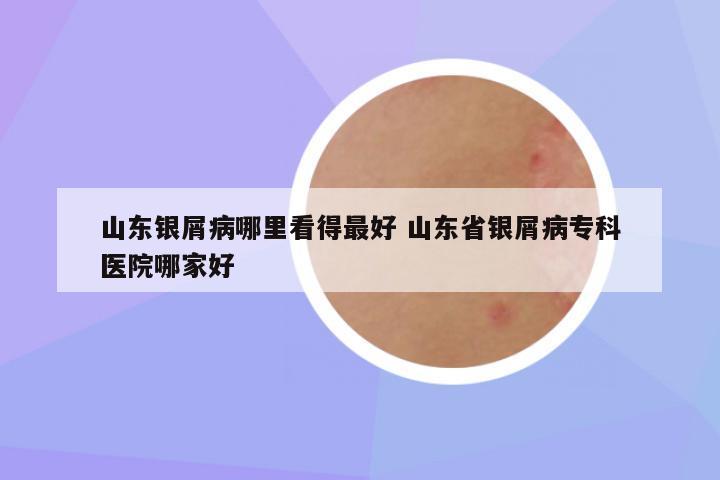 山东银屑病哪里看得最好 山东省银屑病专科医院哪家好