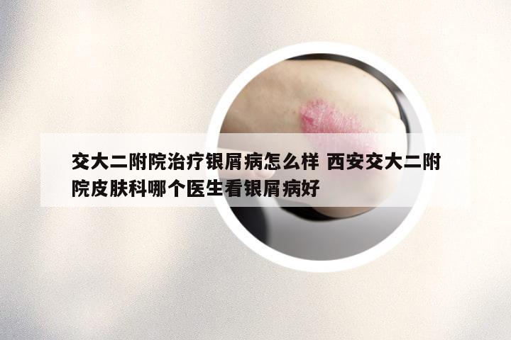 交大二附院治疗银屑病怎么样 西安交大二附院皮肤科哪个医生看银屑病好