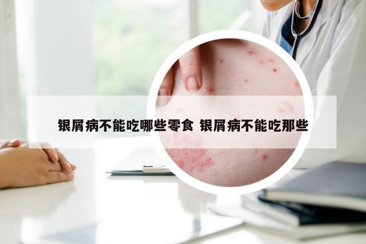 银屑病不能吃哪些零食 银屑病不能吃那些