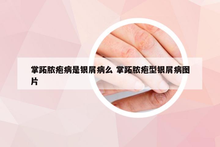 掌跖脓疱病是银屑病么 掌跖脓疱型银屑病图片