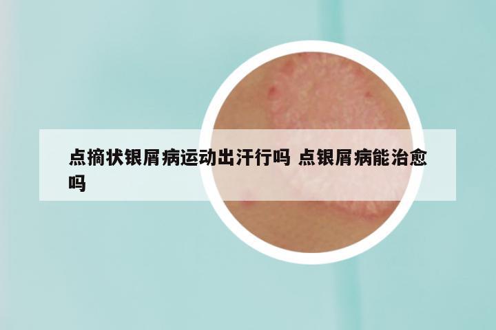 点摘状银屑病运动出汗行吗 点银屑病能治愈吗