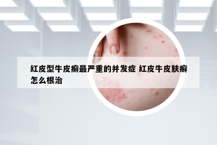 红皮型牛皮癣最严重的并发症 红皮牛皮肤癣怎么根治