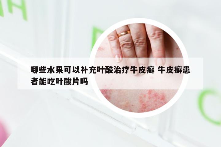哪些水果可以补充叶酸治疗牛皮癣 牛皮癣患者能吃叶酸片吗