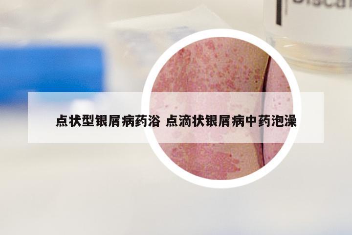 点状型银屑病药浴 点滴状银屑病中药泡澡
