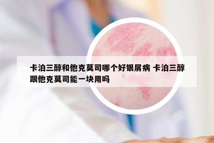 卡泊三醇和他克莫司哪个好银屑病 卡泊三醇跟他克莫司能一块用吗