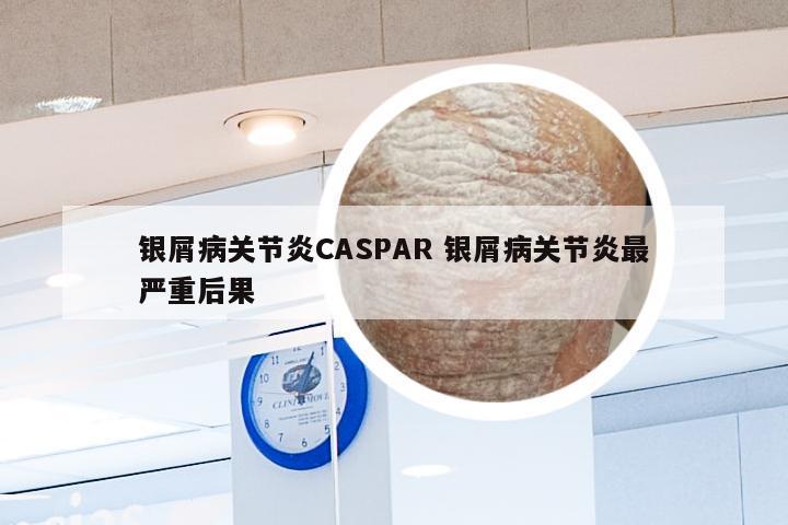 银屑病关节炎CASPAR 银屑病关节炎最严重后果