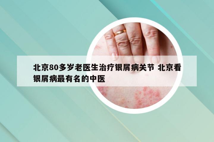 北京80多岁老医生治疗银屑病关节 北京看银屑病最有名的中医