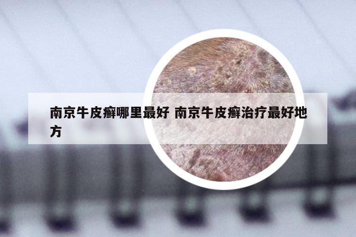 南京牛皮癣哪里最好 南京牛皮癣治疗最好地方