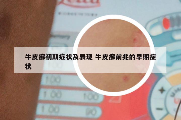 牛皮癣初期症状及表现 牛皮癣前兆的早期症状