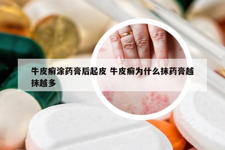 牛皮癣涂药膏后起皮 牛皮癣为什么抹药膏越抹越多