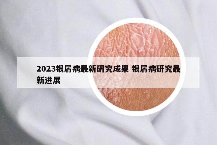 2023银屑病最新研究成果 银屑病研究最新进展
