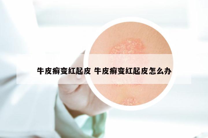 牛皮癣变红起皮 牛皮癣变红起皮怎么办