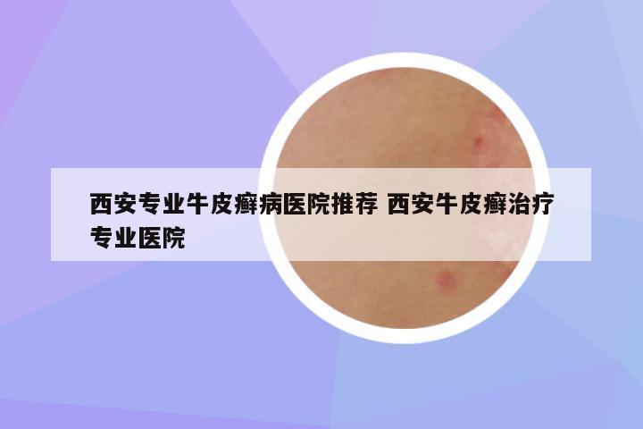 西安专业牛皮癣病医院推荐 西安牛皮癣治疗专业医院