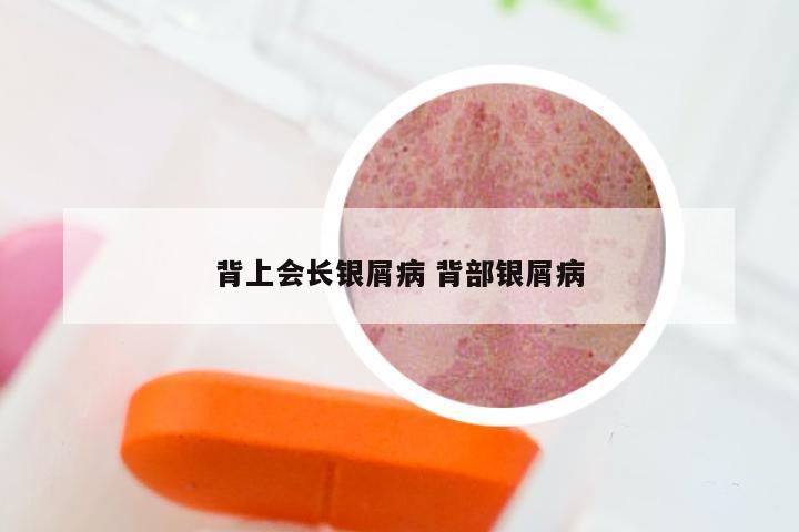 背上会长银屑病 背部银屑病