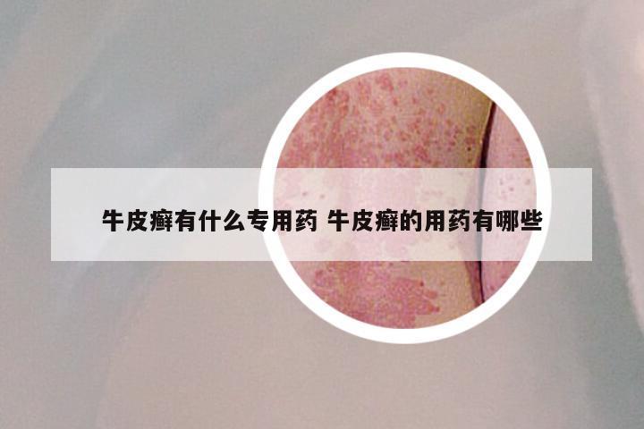 牛皮癣有什么专用药 牛皮癣的用药有哪些