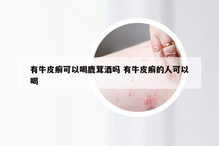有牛皮癣可以喝鹿茸酒吗 有牛皮癣的人可以喝