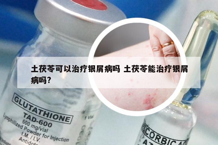 土茯苓可以治疗银屑病吗 土茯苓能治疗银屑病吗?