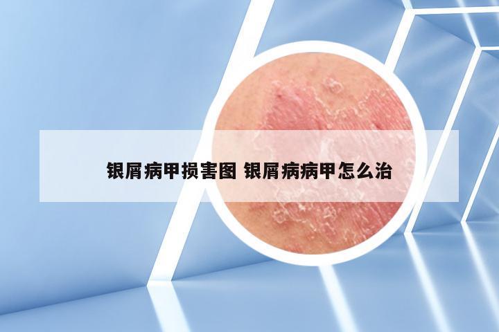 银屑病甲损害图 银屑病病甲怎么治