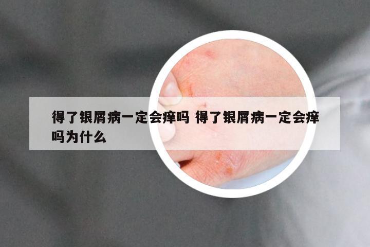 得了银屑病一定会痒吗 得了银屑病一定会痒吗为什么