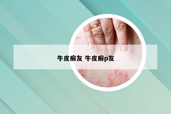 牛皮癣友 牛皮癣p友