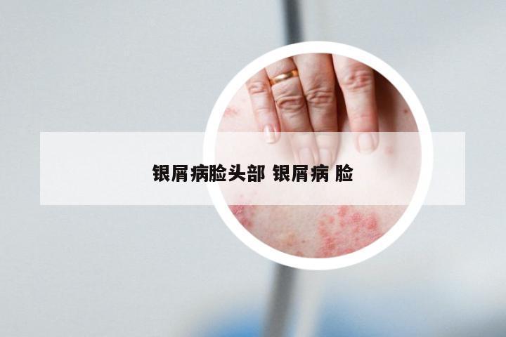 银屑病脸头部 银屑病 脸