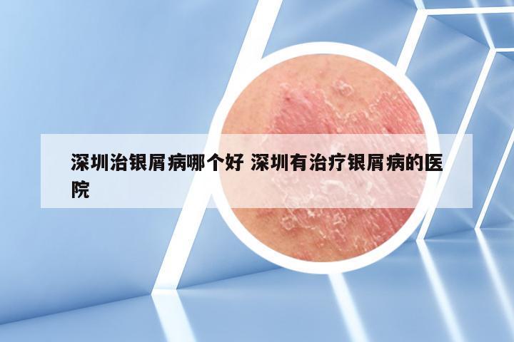 深圳治银屑病哪个好 深圳有治疗银屑病的医院