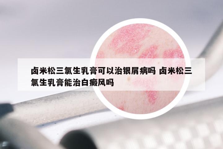 卤米松三氯生乳膏可以治银屑病吗 卤米松三氯生乳膏能治白癜风吗