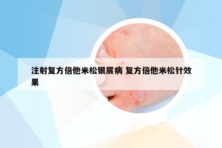 注射复方倍他米松银屑病 复方倍他米松针效果