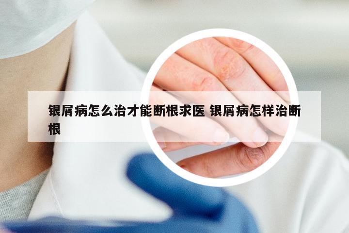银屑病怎么治才能断根求医 银屑病怎样治断根
