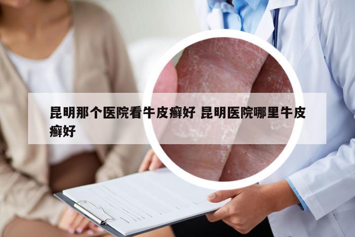 昆明那个医院看牛皮癣好 昆明医院哪里牛皮癣好