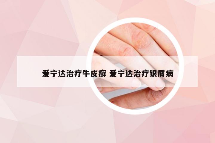 爱宁达治疗牛皮癣 爱宁达治疗银屑病