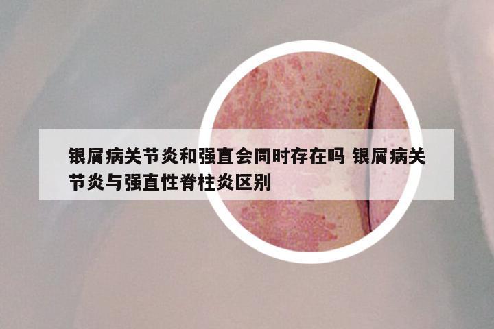 银屑病关节炎和强直会同时存在吗 银屑病关节炎与强直性脊柱炎区别
