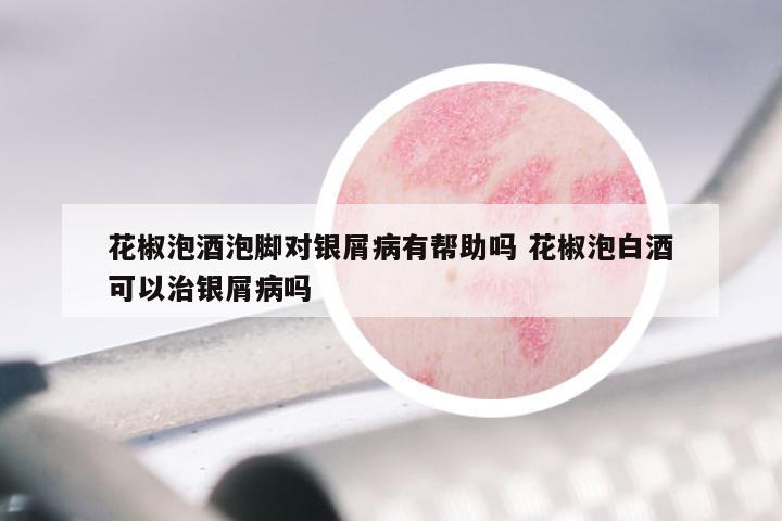 花椒泡酒泡脚对银屑病有帮助吗 花椒泡白酒可以治银屑病吗
