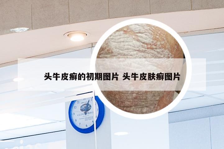 头牛皮癣的初期图片 头牛皮肤癣图片