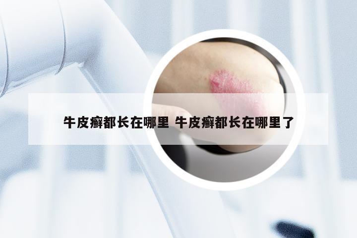 牛皮癣都长在哪里 牛皮癣都长在哪里了