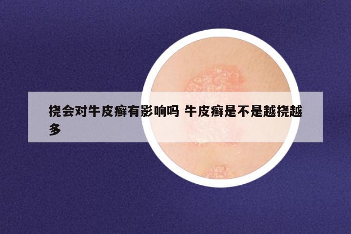 挠会对牛皮癣有影响吗 牛皮癣是不是越挠越多