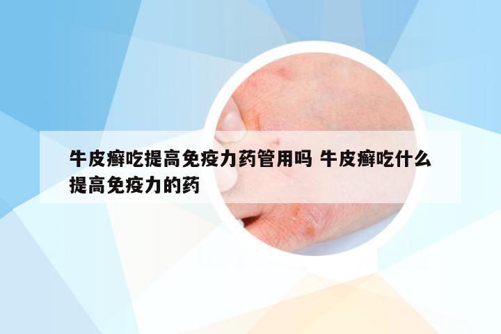 牛皮癣吃提高免疫力药管用吗 牛皮癣吃什么提高免疫力的药