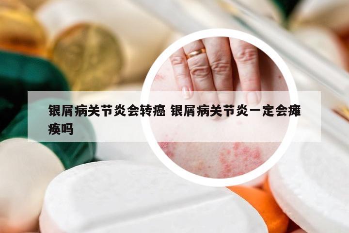 银屑病关节炎会转癌 银屑病关节炎一定会瘫痪吗