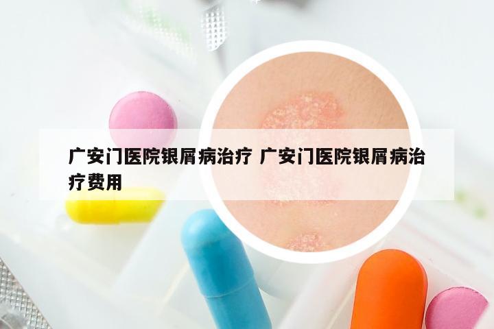 广安门医院银屑病治疗 广安门医院银屑病治疗费用