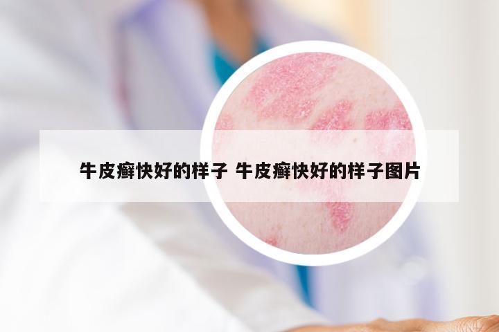 牛皮癣快好的样子 牛皮癣快好的样子图片