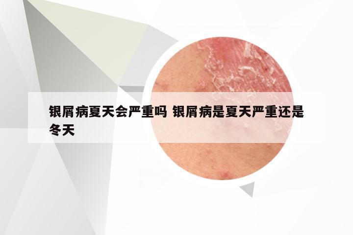 银屑病夏天会严重吗 银屑病是夏天严重还是冬天