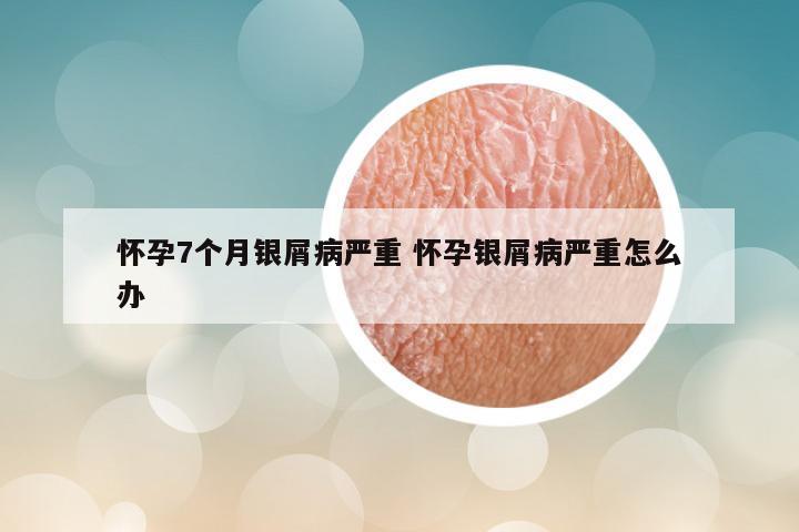 怀孕7个月银屑病严重 怀孕银屑病严重怎么办