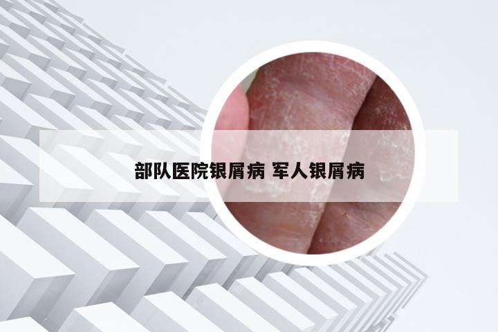 部队医院银屑病 军人银屑病